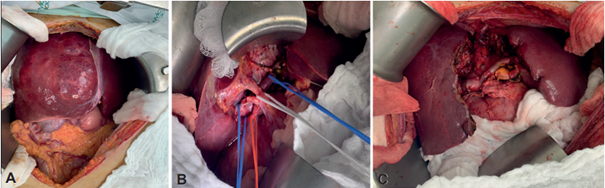 Procedimiento quir�rgico que corresponde al paciente de la Figura 1. A. Hemangioma que compromete los segmentos hep�ticos centrales. B. Disecci�n completa del hilio hep�tico. En vessel loops azul, vena porta derecha e izquierda; vessel loop rojo, arteria hep�tica derecha; vessel loop blanco, v�a biliar. C. Hepatectom�a central previa reconstrucci�n bilio-ent�rica.