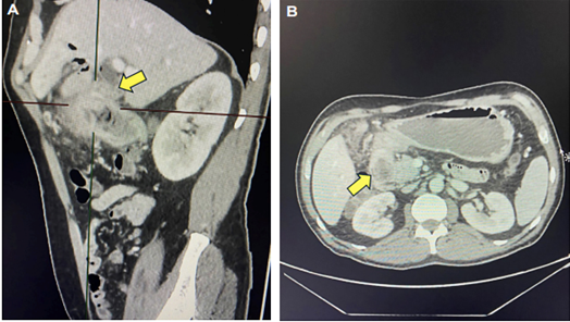 A. Tomograf�a computarizada de abdomen con hallazgo de una colecci�n subhep�tica y cambios inflamatorios del par�nquima hep�tico y la grasa mesent�rica adyacente. B. Adem�s, se aprecia dilataci�n de la v�a biliar y neumobilia, con predominio en los radicales izquierdos.