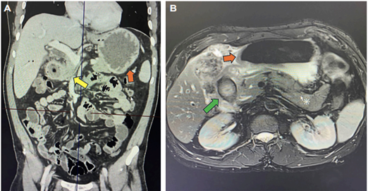 A. Colangiorresonancia con evidencia proceso inflamatorio cr�nico (plastr�n vesicular), que se contin�a con un defecto de la pared lateral y de la primera porci�n del duodeno (flecha amarilla). B. Adem�s, se observa una imagen de localizaci�n intraluminal en la primera porci�n del duodeno, compatible con un c�lculo impactado (flecha verde), con dilataci�n retr�grada del est�mago (flecha naranja).