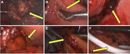 Cirug�a abdominal v�a laparoscopia. A. Remanente de ves�cula biliar posterior a la colecistectom�a subtotal. B. Gastrotom�a longitudinal. C. Visualizaci�n del c�lculo impactado en la primera porci�n del duodeno. D. Fragmentaci�n y extracci�n del c�lculo. E. Gastrorrafia. F. Colocaci�n de dren Jackson-Pratt subhep�tico.
