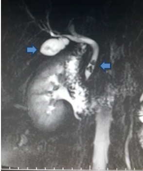 Colangiograf�a por resonancia magn�tica nuclear en la que se aprecia la ves�cula biliar escleroatr�fica, con paredes engrosadas y c�lculos en su interior, en relaci�n con colelitiasis (flecha izquierda). Adem�s hay dilataci�n del tercio distal del col�doco de 8 mm por la presencia de dos c�lculos de morfolog�a facetada y triangular, que miden 4 y 6 mm respectivamente, en relaci�n con coledocolitiasis (flecha derecha).