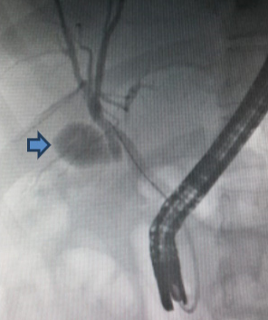 Colangiopancreatograf�a retr�grada endosc�pica que muestra la v�a biliar dilatada, de 9 mm, con defectos de llenamiento en su interior, y la ves�cula biliar escleroatr�fica con colelitiasis m�ltiple (flecha).