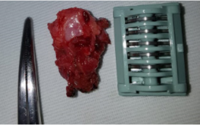 Im�genes de los hallazgos intraoperatorios con un remanente de la ves�cula biliar de paredes engrosadas y m�ltiples c�lculos en su interior.