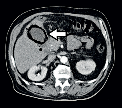 Tomograf�a computarizada en corte axial con contraste oral y venoso. Se observa aire en la pared de la ves�cula biliar (flecha blanca).