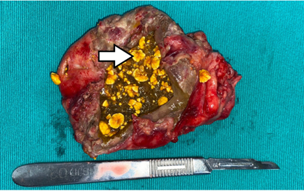 Ves�cula biliar que mide 9x5x4 cm, abierta por el eje mayor. La serosa es opaca, congestiva y con membranas fibrinopurulentas. En el interior hay presencia de m�ltiples formaciones calculosas (flecha blanca), de caracter�sticas mixtas (bistur� quir�rgico para escala).