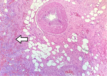 Corte histol�gico de ves�cula biliar, aumento de 40x, te�ido con hematoxilina-eosina. Se observa un infiltrado inflamatorio prominente compuesto por abundantes polimorfonucleares, junto con �reas de necrosis de licuefacci�n focal y hemorragia reciente (flecha blanca).