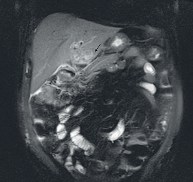 Lesi�n multilobulada en l�bulo absceso hep�tico izquierdo; la flecha muestra el realce perif�rico asociado a la lesi�n.