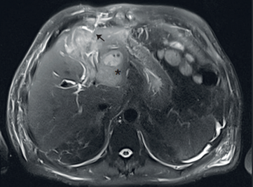 Resonancia magn�tica nuclear de abdomen donde se observan las m�ltiples lesiones confluentes, de aspecto inflamatorio, sobre el l�bulo hep�tico izquierdo, marcados con un asterisco. Se�alado con una flecha se observa la posici�n del dren percut�neo hep�tico.