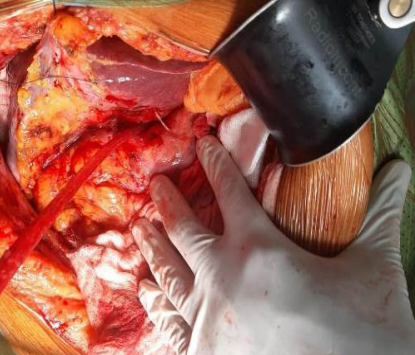 Hallazgo intraoperatorio donde se aprecia el cuerpo extra�o, que perfora desde el antro g�strico hacia el l�bulo hep�tico izquierdo, se�alado por la flecha blanca.