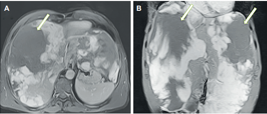Resonancia magn�tica abdominal con contraste. A) Corte axial y B) corte coronal donde se observan hemangiomas cavernosos gigantes, el derecho de 21x20x14 cm y el izquierdo de 24x15x11 cm (flechas blancas).