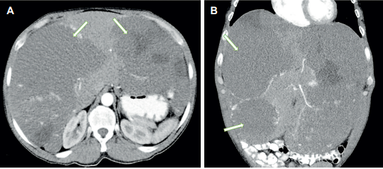 Tomograf�a computarizada de abdomen con contraste. A) Corte axial, muestra hemangioma gigante en l�bulo hep�tico derecho de 19x12x19 cm. B) Corte coronal permite visualizar lesi�n del l�bulo hep�tico izquierdo en segmentos VIII y VIA (flechas blancas).