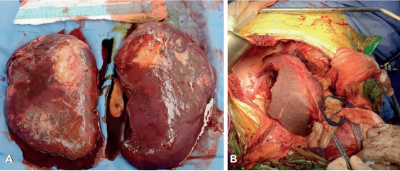 Hepatectom�a de hemangioma hep�tico bilobular (derecho de 24x18 cm e izquierdo de 28x24 cm), con cirug�a hepatopancreatobiliar extrema.