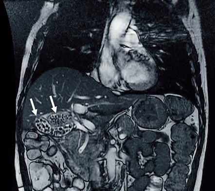 Colangiorresonancia que muestra la duplicaci�n vesicular con colelitiasis m�ltiple en ambas ves�culas (se�aladas con las flechas).