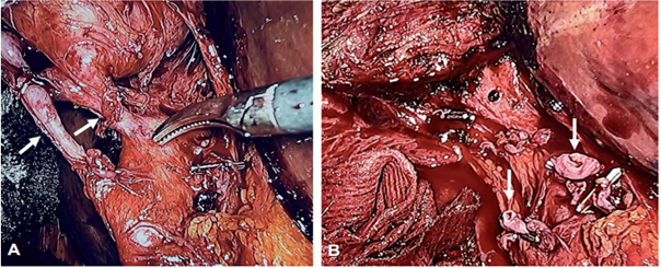 A. Duplicaci�n del conducto c�stico (se�alados con las flechas). B. Conductos c�sticos con clips (se�alados con las flechas).