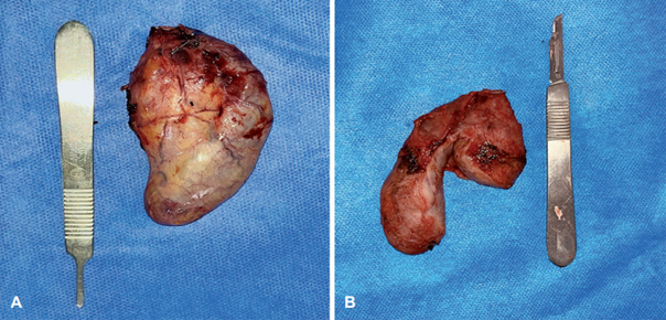 A. Cuerpos vesiculares fusionados con un peritoneo en com�n. B. Posterior a la disecci�n del esp�cimen se observa una configuraci�n de ves�cula tipo H.