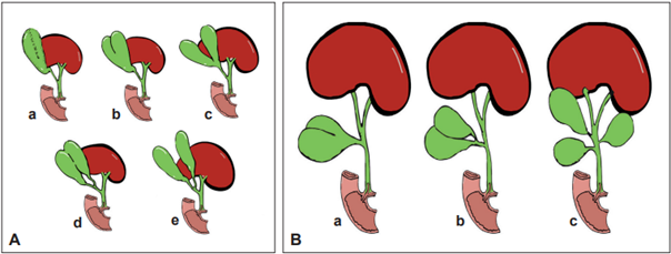 A. &lsquo;Vesica fellea divisum&rsquo; y sus diferentes tipos de presentaciones. B. Clasificaci�n de Boyden: a. Ves�cula bilobulada; b. Ves�cula tipo Y; c. Ves�cula tipo H en sus diferentes localizaciones.