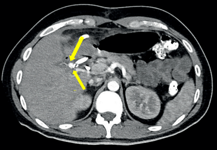 Corte axial de tomograf�a computarizada de abdomen con contraste en fase arterial, donde se observa una imagen compatible con pseudoaneurisma dependiente de la arteria hep�tica izquierda, adyacente al material met�lico clip (se�alada con flecha amarilla).