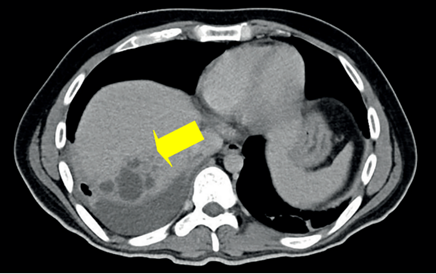 Corte axial de tomograf�a computarizada de abdomen con contraste en fase arterial donde reportaron zonas sugestivas de abscesos hep�ticos hacia los segmentos VII y VI, ausencia quir�rgica de ves�cula biliar y colecci�n perihep�tica de 16 ml, con aire en su interior y nivel hidroa�reo.