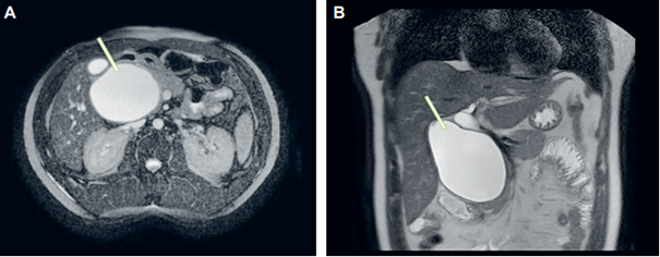 Colangiorresonancia magn�tica abdominal con contraste, con sus cortes axial (A) y sagital (B) en los cuales se observa un quiste del col�doco clasificaci�n I subtipo C.
