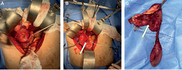 A. Quiste del col�doco, reparo de la arteria gastroduodenal. B. Resecci�n de quiste del col�doco posterior a colecistectom�a. C. Pieza quir�rgica, donde se incluyen el quiste y la ves�cula biliar.