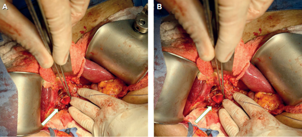 Reconstrucci�n de v�a biliar posterior a resecci�n de quiste del col�doco.