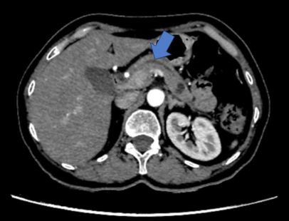 Tomograf�a de abdomen y pelvis, donde se observa el p�ncreas de tama�o, contornos y densidad normal. En el cuerpo se identifica una imagen hipodensa, redondeada, de 12,8 mm de di�metro, de contornos levemente lobulados y aspecto qu�stico.