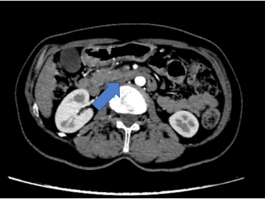 Tomograf�a de abdomen y pelvis, que muestra la comunicaci�n con el conducto pancre�tico principal, el cual se encuentra discretamente dilatado en toda su extensi�n, con di�metro de 3 mm, y emerge directamente a la segunda porci�n del duodeno.