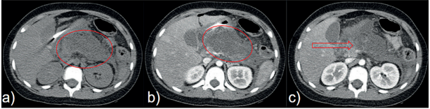 a) Tomograf�a computarizada (TC) de abdomen simple donde se aprecia aumento del volumen pancre�tico (circunferencia roja). b) TC con contraste en fase arterial, que permite visualizar mejor el aumento del volumen pancre�tico (circunferencia roja). c) La TC de abdomen con contraste intravenoso de control mostr� ausencia de realce pancre�tico, compatible con necrosis pancre�tica (flecha roja).