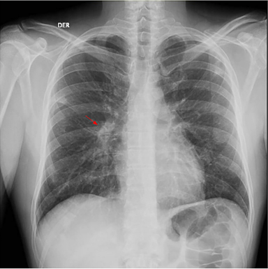Radiograf�a de t�rax al ingreso a urgencias donde se observa un peque�o foco neum�nico por encima de la cisura menor derecha (flecha roja), sin lesiones l�ticas ni bl�sticas.