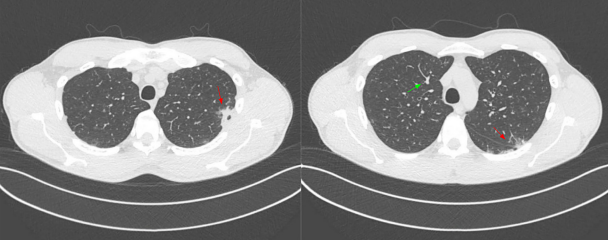 Angiotomograf�a computarizada de t�rax: Par�nquima pulmonar con m�ltiples zonas de ocupaci�n alveolar, con patr�n mixto en vidrio esmerilado y de condensaci�n alveolar, con algunas im�genes nodulares subcentim�tricas subpleurales (flecha verde), con densidad de tejidos blandos, alguna de ellas llegando a conformar un patr�n de aspecto pseudonodular (flecha roja), que hace sospechar origen inflamatorio/infeccioso.