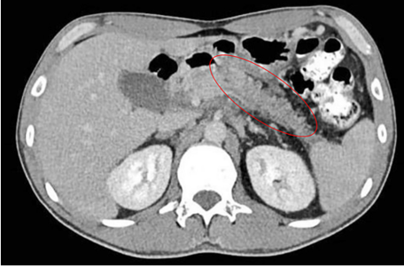 Tomograf�a computarizada de abdomen con hipodensidad difusa que compromete parte del cuello, cuerpo y cola del p�ncreas, sin definir lesiones nodulares focales. Discretos cambios por edema de la grasa a nivel peripancre�tico, adyacente a la zona de compromiso difuso (elipse roja).