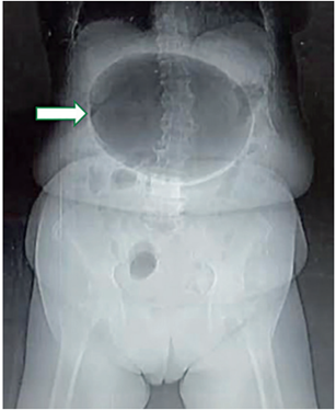 Radiograf�a de abdomen simple en bipedestaci�n, donde se aprecia una lesi�n de aspecto esf�rica, centroabdominal, con contenido a�reo (flecha).