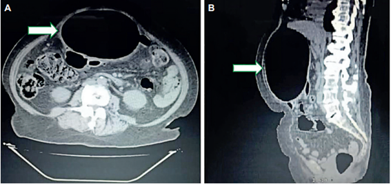 Tomograf�a computarizada de abdomen. A. Corte axial donde se evidencia gran dilataci�n qu�stica asociado a las asas del colon izquierdo (flecha); B. Corte sagital con gran dilataci�n de contenido a�reo dependiente de colon izquierdo (flecha).