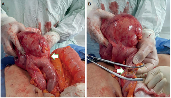 Hallazgos intraoperatoria en laparotom�a exploratoria. A. Duplicaci�n qu�stica de colon izquierdo (flecha). B. Resecci�n de malformaci�n qu�stica del colon izquierdo (flecha).