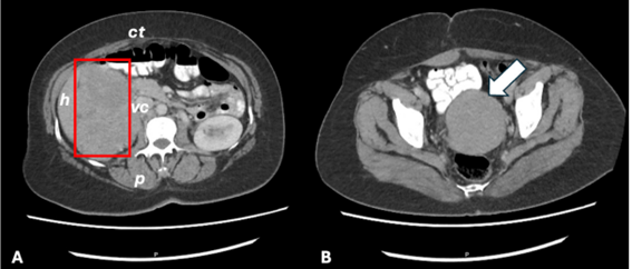 A. Corte axial de tomograf�a computarizada de abdomen y pelvis donde se aprecia el tumor retroperitoneal (cuadro rojo) en contacto con el borde inferior del h�gado (h), colon transverso (ct), vena cava (vc) y m�sculo psoas (p). B. Corte axial de tomograf�a computarizada de abdomen y pelvis en la que se observa el mioma en mu��n cervical (flecha blanca).
