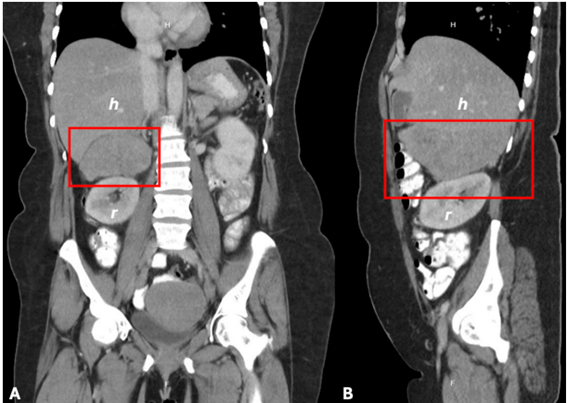 A. Corte coronal (A) y sagital (B) de tomograf�a computarizada de abdomen y pelvis donde se observa el leiomioma retroperitoneal (cuadro rojo) inferior al h�gado (h) y superior al ri��n derecho (r).