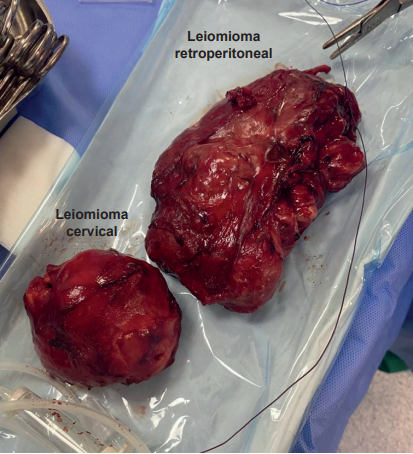 Tumores de m�sculo liso originados en el c�rvix (leiomioma cervical) a la izquierda de la imagen y tumor retroperitoneal (leiomioma retroperitoneal) a la derecha de la imagen.