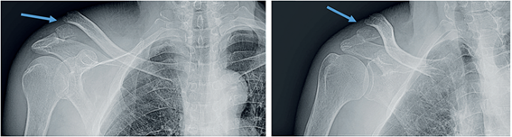 Radiograf�a anteroposterior del hombro derecho. La flecha se�ala la fractura de tercio distal de la clav�cula derecha desplazada.