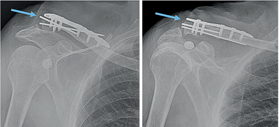 Radiograf�a de control postoperatorio que muestra la osteos�ntesis de clav�cula derecha con placa y clavos de Kirschner.