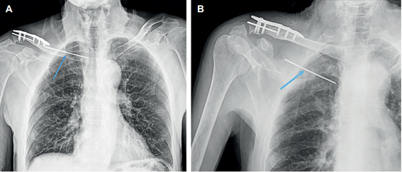 Migraci�n del clavo de Kirschner. A. Radiograf�a de t�rax. La flecha se�ala el clavo de Kirschner desplazado hacia cavidad tor�cica. B. Radiograf�a de hombro derecho. La flecha se�ala el clavo de Kirschner desplazado hacia el �pice pulmonar derecho.