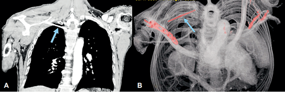 Tomograf�a computarizada de t�rax con contraste. A. Corte coronal. La flecha se�ala el clavo de Kirschner en el �pice pulmonar derecho. B. Angiotomograf�a 3D que muestra el clavo de Kirschner en el �pice pulmonar derecho y los vasos sangu�neos sin lesiones.