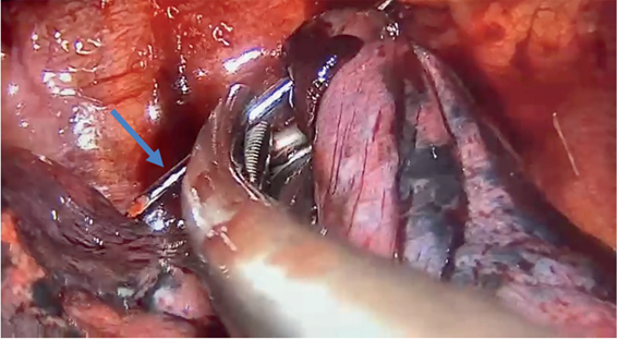 Toracoscopia. La flecha se�ala el clavo de Kirschner con la punta hacia mediastino superior sin comprometer estructuras vitales, siendo tomado por la pinza para desinsertarlo desde el l�bulo superior del pulm�n previo a la extracci�n.