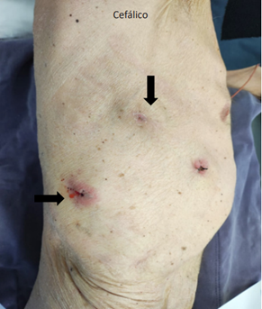 Tumefacciones en pared tor�cica lateral derecha (paciente en dec�bito lateral izquierdo), sobre la l�nea axilar media con sexto espacio intercostal y sobre la l�nea axilar posterior con d�cimo espacio intercostal (flechas). La lesi�n m�s anterior corresponde al sitio de inserci�n del dren.