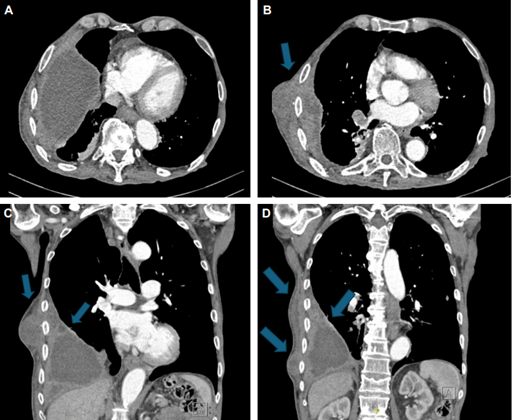 Tomograf�a axial computarizada donde se aprecia la presencia de l�quido pleural loculado, con engrosamiento pleural y comunicaci�n con la pared tor�cica. A. Corte axial, la flecha se�ala el empiema. B. Corte axial, la flecha se�ala el empiema que comunica con la pared tor�cica. C y D. Cortes coronales, las flechas se�alan el empiema y las tumefacciones en la pared tor�cica.