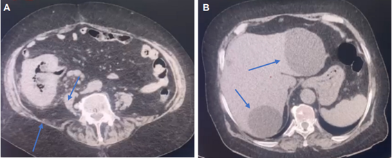 A. Tomograf�a axial computarizada simple de abdomen en corte axial donde se observan cambios inflamatorios en la pared del ciego, estriaci�n grasa a nivel del ap�ndice vermiforme y plastr�n inflamatorio, adem�s de aumento de volumen de ganglios linf�ticos en fosa iliaca derecha. B. Hallazgo incidental de lesiones qu�sticas en el interior del par�nquima hep�tico, en regi�n en l�bulo derecho e izquierdo del h�gado.