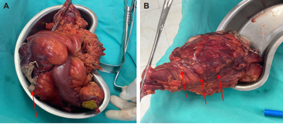 A. Bloque quir�rgico extra�do del producto de hemicolectom�a derecha, donde se observa perforaci�n de la base del ap�ndice con necrosis licuefactiva en toda su extensi�n (flecha), un aspecto fibrinoide y purulento del ciego y colon ascendente. B. Macrosc�picamente se observan vasos mesent�ricos edematosos y trombosados, as� como aumento de volumen de ganglios mesent�ricos (flechas).
