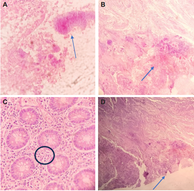 A.-B. Corte histol�gico de un segmento de �leon distal te�ido con hematoxilina-eosina (H-E) con bacilos Gram positivos presentes en el interior de las c�lulas mucosas secretoras epiteliales. Se observan los �gr�nulos de azufre� (flechas) en el interior de la l�mina propia del �leon con enfoque 40x. C. Presencia de bacterias filiformes Gram positivas en el interior de enterocitos de �leon distal. 40x, hematoxilina-eosina (H-E) D. Se observan agrupaciones de gr�nulos azur�filos a nivel de la l�mina propia con enfoque 10x, hematoxilina-eosina (H-E).