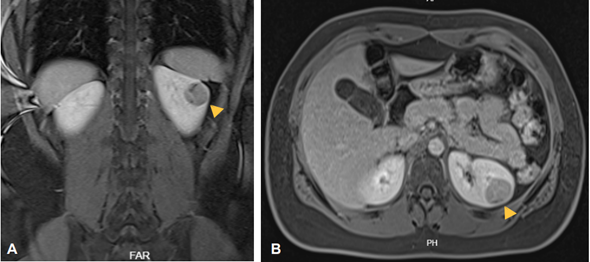 Resonancia magn�tica de abdomen y pelvis con contraste. A. Vista en corte coronal T2, sobre la valva posterior de la silueta renal izquierda se observa lesi�n nodular s�lida, heterog�nea y ligeramente hipointensa (flecha amarilla). B. Vista en corte axial T2, se observa lesi�n hipointensa en ri��n izquierdo de bordes definidos (flecha amarilla).