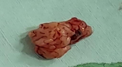 Hallazgo quir�rgico: tumor de consistencia dura y bordes definidos, de 3x3 cm.