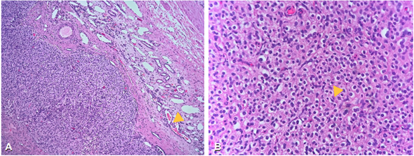 Patolog�a quir�rgica. A. Tinci�n de hematoxilina/eosina, 50X. Tumoraci�n que empuja el par�nquima renal y no sobrepasa la c�psula (flecha amarilla). B. Tinci�n de hematoxilina/eosina, 100X. Presencia de c�lulas poligonales y redondas (flecha amarilla).